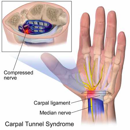 Salud laboral sindrome tunel carpiano